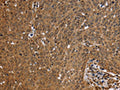 The image on the left is immunohistochemistry of paraffin-embedded Human cervical cancer tissue using CSB-PA798885(FHL2 Antibody) at dilution 1/50, on the right is treated with fusion protein. (Original magnification: ×200)