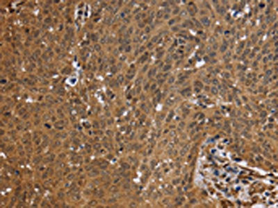 The image on the left is immunohistochemistry of paraffin-embedded Human cervical cancer tissue using CSB-PA798885(FHL2 Antibody) at dilution 1/50, on the right is treated with fusion protein. (Original magnification: ×200)