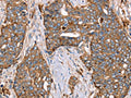The image on the left is immunohistochemistry of paraffin-embedded Human cervical cancer tissue using CSB-PA799040(FUCA1 Antibody) at dilution 1/30, on the right is treated with fusion protein. (Original magnification: ×200)