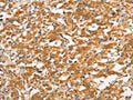 The image on the left is immunohistochemistry of paraffin-embedded Human thyroid cancer tissue using CSB-PA799580(ANKMY2 Antibody) at dilution 1/30, on the right is treated with fusion protein. (Original magnification: ×200)