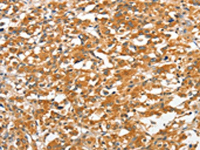 The image on the left is immunohistochemistry of paraffin-embedded Human thyroid cancer tissue using CSB-PA799580(ANKMY2 Antibody) at dilution 1/30, on the right is treated with fusion protein. (Original magnification: ×200)