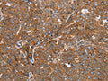 The image on the left is immunohistochemistry of paraffin-embedded Human ovarian cancer tissue using CSB-PA799827(NDUFS2 Antibody) at dilution 1/50, on the right is treated with synthetic peptide. (Original magnification: ×200)