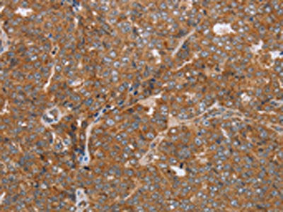 The image on the left is immunohistochemistry of paraffin-embedded Human ovarian cancer tissue using CSB-PA799827(NDUFS2 Antibody) at dilution 1/50, on the right is treated with synthetic peptide. (Original magnification: ×200)