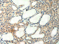 The image on the left is immunohistochemistry of paraffin-embedded Human thyroid cancer tissue using CSB-PA801486(AGRN Antibody) at dilution 1/50, on the right is treated with synthetic peptide. (Original magnification: ×200)