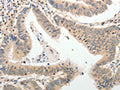 The image on the left is immunohistochemistry of paraffin-embedded Human colon cancer  tissue using CSB-PA801690(ADAMTS2 Antibody) at dilution 1/25, on the right is treated with synthetic peptide. (Original magnification: ×200)