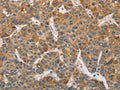 The image on the left is immunohistochemistry of paraffin-embedded Human liver cancer tissue using CSB-PA801951(DDX53 Antibody) at dilution 1/75, on the right is treated with fusion protein. (Original magnification: ×200)