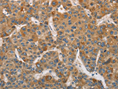 The image on the left is immunohistochemistry of paraffin-embedded Human liver cancer tissue using CSB-PA801951(DDX53 Antibody) at dilution 1/75, on the right is treated with fusion protein. (Original magnification: ×200)
