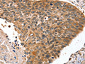 The image on the left is immunohistochemistry of paraffin-embedded Human esophagus cancer tissue using CSB-PA803064(HOXB1 Antibody) at dilution 1/30, on the right is treated with fusion protein. (Original magnification: ×200)