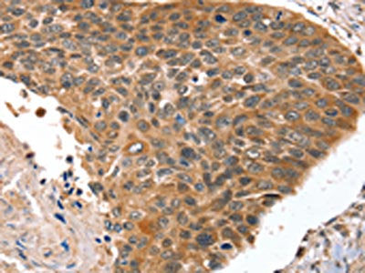 The image on the left is immunohistochemistry of paraffin-embedded Human esophagus cancer tissue using CSB-PA803064(HOXB1 Antibody) at dilution 1/30, on the right is treated with fusion protein. (Original magnification: ×200)