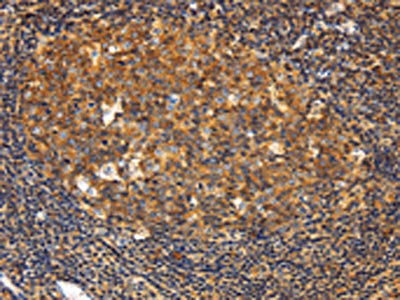 The image on the left is immunohistochemistry of paraffin-embedded Human tonsil tissue using CSB-PA805573(GNA13 Antibody) at dilution 1/20, on the right is treated with fusion protein. (Original magnification: ×200)