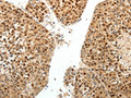 The image on the left is immunohistochemistry of paraffin-embedded Human liver cancer tissue using CSB-PA807056(SPATA2L Antibody) at dilution 1/30, on the right is treated with fusion protein. (Original magnification: ×200)