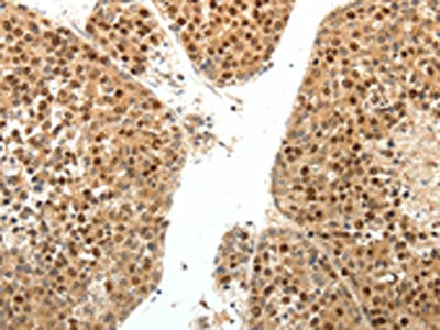 The image on the left is immunohistochemistry of paraffin-embedded Human liver cancer tissue using CSB-PA807056(SPATA2L Antibody) at dilution 1/30, on the right is treated with fusion protein. (Original magnification: ×200)