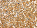 The image on the left is immunohistochemistry of paraffin-embedded Human thyroid cancer tissue using CSB-PA808759(SPTLC1 Antibody) at dilution 1/25, on the right is treated with fusion protein. (Original magnification: ×200)
