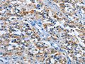 The image on the left is immunohistochemistry of paraffin-embedded Human thyroid cancer tissue using CSB-PA808765(ETHE1 Antibody) at dilution 1/20, on the right is treated with fusion protein. (Original magnification: ×200)