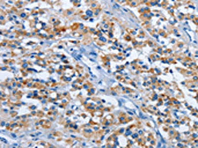 The image on the left is immunohistochemistry of paraffin-embedded Human thyroid cancer tissue using CSB-PA808765(ETHE1 Antibody) at dilution 1/20, on the right is treated with fusion protein. (Original magnification: ×200)