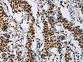 The image on the left is immunohistochemistry of paraffin-embedded Human gastic cancer tissue using CSB-PA809269(IL17C Antibody) at dilution 1/50, on the right is treated with synthetic peptide. (Original magnification: ×200)