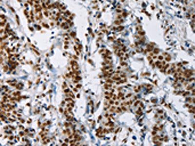 The image on the left is immunohistochemistry of paraffin-embedded Human gastic cancer tissue using CSB-PA809269(IL17C Antibody) at dilution 1/50, on the right is treated with synthetic peptide. (Original magnification: ×200)