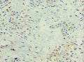 Immunohistochemistry of paraffin-embedded human breast cancer using CSB-PA811596ESR2HU at dilution of 1:100