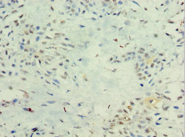 Immunohistochemistry of paraffin-embedded human breast cancer using CSB-PA811596ESR2HU at dilution of 1:100