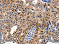 The image on the left is immunohistochemistry of paraffin-embedded Human ovarian cancer tissue using CSB-PA811751(MCM7 Antibody) at dilution 1/15, on the right is treated with fusion protein. (Original magnification: ×200)