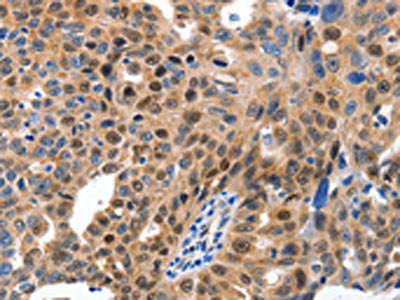 The image on the left is immunohistochemistry of paraffin-embedded Human ovarian cancer tissue using CSB-PA811751(MCM7 Antibody) at dilution 1/15, on the right is treated with fusion protein. (Original magnification: ×200)
