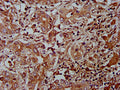 IHC image of CSB-PA812872LA01HU diluted at 1:400 and staining in paraffin-embedded human liver cancer performed on a Leica BondTM system. After dewaxing and hydration, antigen retrieval was mediated by high pressure in a citrate buffer (pH 6.0). Section was blocked with 10% normal goat serum 30min at RT. Then primary antibody (1% BSA) was incubated at 4&deg;C overnight. The primary is detected by a biotinylated secondary antibody and visualized using an HRP conjugated SP system.