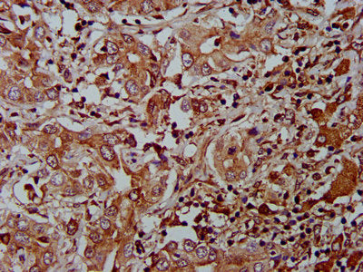 IHC image of CSB-PA812872LA01HU diluted at 1:400 and staining in paraffin-embedded human liver cancer performed on a Leica BondTM system. After dewaxing and hydration, antigen retrieval was mediated by high pressure in a citrate buffer (pH 6.0). Section was blocked with 10% normal goat serum 30min at RT. Then primary antibody (1% BSA) was incubated at 4&deg;C overnight. The primary is detected by a biotinylated secondary antibody and visualized using an HRP conjugated SP system.