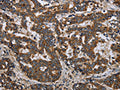 The image on the left is immunohistochemistry of paraffin-embedded Human liver cancer tissue using CSB-PA813147(LGALS2 Antibody) at dilution 1/30, on the right is treated with fusion protein. (Original magnification: ×200)