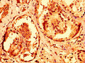 IHC image of CSB-PA814236LA01HU diluted at 1:600 and staining in paraffin-embedded human prostate cancer performed on a Leica BondTM system. After dewaxing and hydration, antigen retrieval was mediated by high pressure in a citrate buffer (pH 6.0). Section was blocked with 10% normal goat serum 30min at RT. Then primary antibody (1% BSA) was incubated at 4°C overnight. The primary is detected by a biotinylated secondary antibody and visualized using an HRP conjugated SP system.