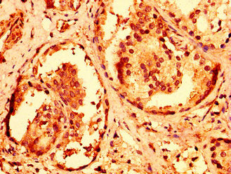 IHC image of CSB-PA814236LA01HU diluted at 1:600 and staining in paraffin-embedded human prostate cancer performed on a Leica BondTM system. After dewaxing and hydration, antigen retrieval was mediated by high pressure in a citrate buffer (pH 6.0). Section was blocked with 10% normal goat serum 30min at RT. Then primary antibody (1% BSA) was incubated at 4°C overnight. The primary is detected by a biotinylated secondary antibody and visualized using an HRP conjugated SP system.