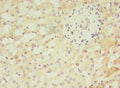 Immunohistochemistry of paraffin-embedded human liver cancer using CSB-PA815551LA01HU at dilution of 1:100