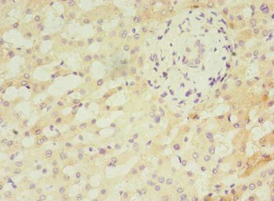 Immunohistochemistry of paraffin-embedded human liver cancer using CSB-PA815551LA01HU at dilution of 1:100
