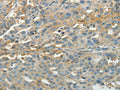 The image on the left is immunohistochemistry of paraffin-embedded Human ovarian cancer tissue using CSB-PA815853(PXN Antibody) at dilution 1/40, on the right is treated with synthetic peptide. (Original magnification: ×200)