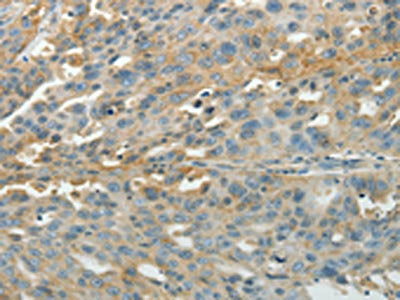 The image on the left is immunohistochemistry of paraffin-embedded Human ovarian cancer tissue using CSB-PA815853(PXN Antibody) at dilution 1/40, on the right is treated with synthetic peptide. (Original magnification: ×200)
