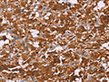 The image on the left is immunohistochemistry of paraffin-embedded Human thyroid cancer tissue using CSB-PA815855(DCBLD2 Antibody) at dilution 1/50, on the right is treated with fusion protein. (Original magnification: ×200)