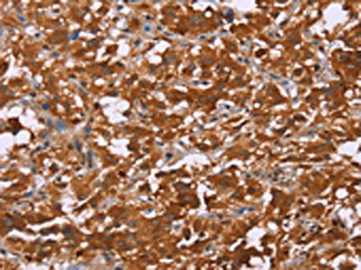 The image on the left is immunohistochemistry of paraffin-embedded Human thyroid cancer tissue using CSB-PA815855(DCBLD2 Antibody) at dilution 1/50, on the right is treated with fusion protein. (Original magnification: ×200)