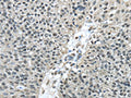 The image on the left is immunohistochemistry of paraffin-embedded Human breast cancer tissue using CSB-PA815873(FUS Antibody) at dilution 1/40, on the right is treated with fusion protein. (Original magnification: ×200)