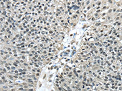 The image on the left is immunohistochemistry of paraffin-embedded Human breast cancer tissue using CSB-PA815873(FUS Antibody) at dilution 1/40, on the right is treated with fusion protein. (Original magnification: ×200)