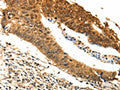 The image on the left is immunohistochemistry of paraffin-embedded Human colon cancer tissue using CSB-PA818178(ODC1 Antibody) at dilution 1/25, on the right is treated with fusion protein. (Original magnification: ×200)