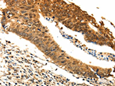 The image on the left is immunohistochemistry of paraffin-embedded Human colon cancer tissue using CSB-PA818178(ODC1 Antibody) at dilution 1/25, on the right is treated with fusion protein. (Original magnification: ×200)