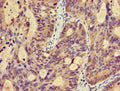 Immunohistochemistry of paraffin-embedded human colon cancer using CSB-PA818265LA01HU at dilution of 1:100
