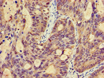 Immunohistochemistry of paraffin-embedded human colon cancer using CSB-PA818265LA01HU at dilution of 1:100
