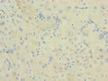 Immunohistochemistry of paraffin-embedded human liver cancer using CSB-PA819454LA01HU at dilution of 1:100