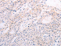 The image on the left is immunohistochemistry of paraffin-embedded Human liver cancer tissue using CSB-PA820027(TSHR Antibody) at dilution 1/50, on the right is treated with fusion protein. (Original magnification: ×200)