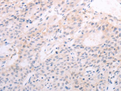 The image on the left is immunohistochemistry of paraffin-embedded Human liver cancer tissue using CSB-PA820027(TSHR Antibody) at dilution 1/50, on the right is treated with fusion protein. (Original magnification: ×200)