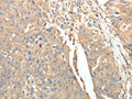 The image on the left is immunohistochemistry of paraffin-embedded Human ovarian cancer tissue using CSB-PA820032(SFTPD Antibody) at dilution 1/30, on the right is treated with fusion protein. (Original magnification: ×200)