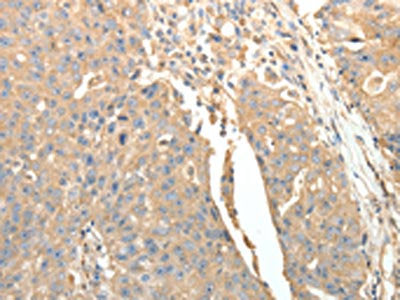 The image on the left is immunohistochemistry of paraffin-embedded Human ovarian cancer tissue using CSB-PA820032(SFTPD Antibody) at dilution 1/30, on the right is treated with fusion protein. (Original magnification: ×200)