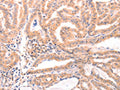 The image on the left is immunohistochemistry of paraffin-embedded Human thyroid cancer tissue using CSB-PA821404(DAZ4 Antibody) at dilution 1/50, on the right is treated with fusion protein. (Original magnification: ×200)