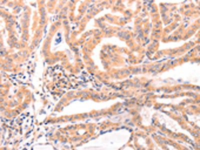 The image on the left is immunohistochemistry of paraffin-embedded Human thyroid cancer tissue using CSB-PA821404(DAZ4 Antibody) at dilution 1/50, on the right is treated with fusion protein. (Original magnification: ×200)
