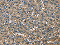 The image on the left is immunohistochemistry of paraffin-embedded Human liver cancer tissue using CSB-PA821534(ENO1 Antibody) at dilution 1/60, on the right is treated with fusion protein. (Original magnification: ×200)